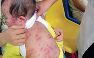 Những biến chứng đáng sợ của bệnh sởi