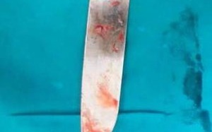 Cứu sống nữ bệnh nhân bị dao đâm sâu vào cơ thể 12 cm