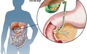 Giữ chi viên sỏi trong túi mật?