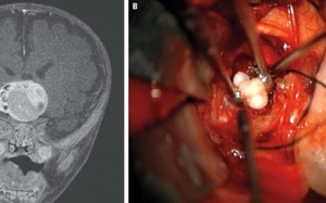 Chuyện hy hữu: Bé trai có răng mọc trong khối u não