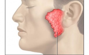 Bài thuốc chữa quai bị