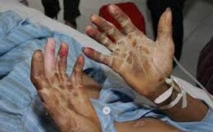 Điểm danh những trọng bệnh do ăn nội tạng động vật