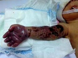 Cứu cánh tay trẻ sơ sinh bị hoại tử