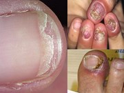 Giao mùa xuân hè: Đối phó với bệnh nấm móng
