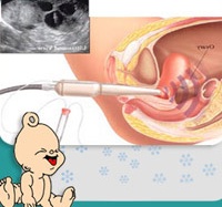 Sai lầm tai hại về thụ tinh ống nghiệm