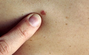 Ngăn ngừa ung thư da, kem chống nắng là chưa đủ