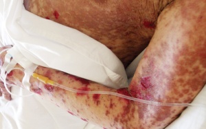 Ngộ độc paracetamol