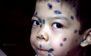 Nhiều điểm tiêm chủng chưa có vaccine thủy đậu