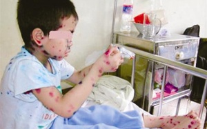 Thiếu vaccine: 'Chẳng có gì nghiêm trọng' (?!)