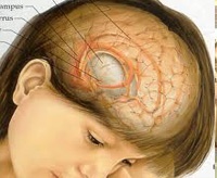 Đau đầu + chủ quan... u não