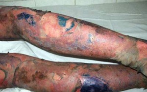 Dị ứng thuốc - nguy hiểm chết người!