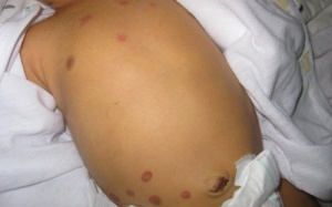 Một trẻ sơ sinh nguy kịch vì 'bà lang vườn'