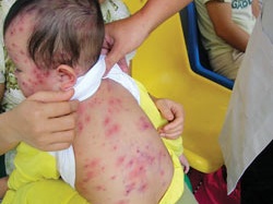 Những trường hợp không tiêm vaccine thủy đậu