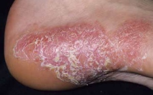 Stress kéo dài khiến bệnh vẩy nến trầm trọng hơn