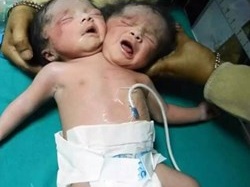 Em bé 2 đầu chào đời ở Ấn Độ