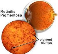 Bệnh 'quáng gà' dưới góc nhìn của y học hiện đại
