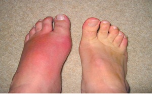 Bệnh gout và cách chữa trị