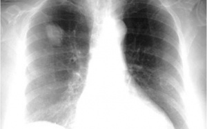 Cảnh báo tình trạng chủng lao kháng thuốc trên toàn cầu