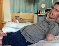 Bị vi khuẩn 'ăn' mất 3 chi và nửa khuôn mặt