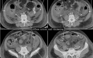 Những điều cần biết về viêm đại tràng màng giả