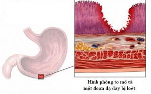 Viêm loét dạ dày mạn tính, làm sao chữa khỏi