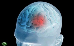 Có thể tránh được chấn thương não sau đột quỵ