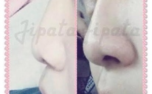 Nâng sống mũi bằng serum: hại thân mà không biết