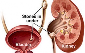 Tự trị sỏi thận từ chế độ ăn uống