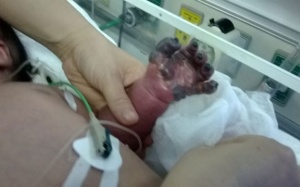 Trẻ sơ sinh bị hoại tử cánh tay sau tiêm phòng lao