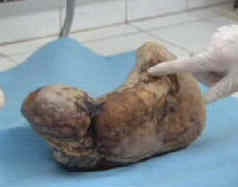 Cụ bà 76 tuổi mang thai... đá