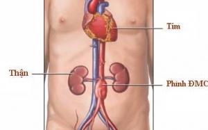 Chứng phình động mạch chủ bụng ở người cao tuổi