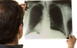 Châu Âu - 'điểm nóng' của bệnh lao