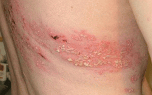 Phân biệt bệnh viêm da do tiếp xúc với côn trùng và bệnh Zona