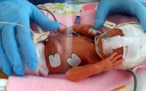 Scotland: Em bé sinh non chỉ nặng 1,3kg sống sót kỳ diệu