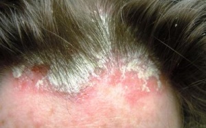 Vẩy nến da đầu: Cần kiên trì điều trị!