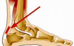 Chứng viêm gân và cách phòng chữa