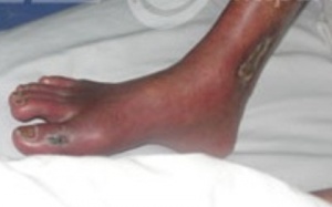 Xương gãy, đắp lá - đoạn chi