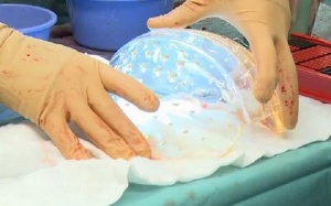 Hà Lan: Cấy ghép thành công hộp sọ 3D cho một phụ nữ