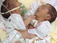 Hai trẻ sơ sinh dính nhau phần bụng