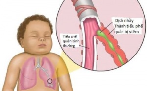 Trời nồm, cảnh giác với bệnh viêm tiểu phế quản