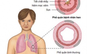 Bệnh hen: Những cảnh báo của bác sĩ