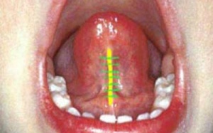 Dính thắng lưỡi là bệnh gì?