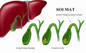 Tán sỏi mật: Cần 'bốn mặt giáp công'