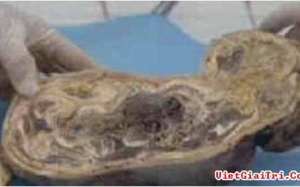 Thông tin mới về vụ cụ bà mang thai đá