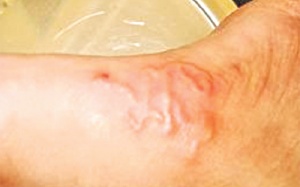 Dùng thuốc điều trị giun sán đúng cách