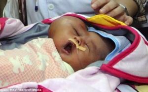 Indonesia: Em bé có đầu hình trái tim