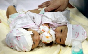 BV Nhi Trung ương: Song sinh dính nhau không quá phức tạp