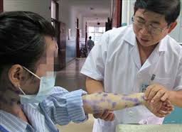 Những trường hợp không tiêm vaccine thủy đậu