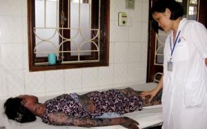 Dị ứng thuốc rộ theo mùa