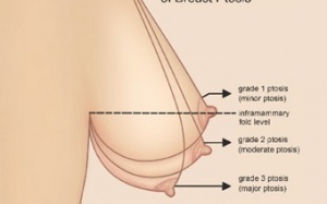 Để ngực không bị chảy xệ